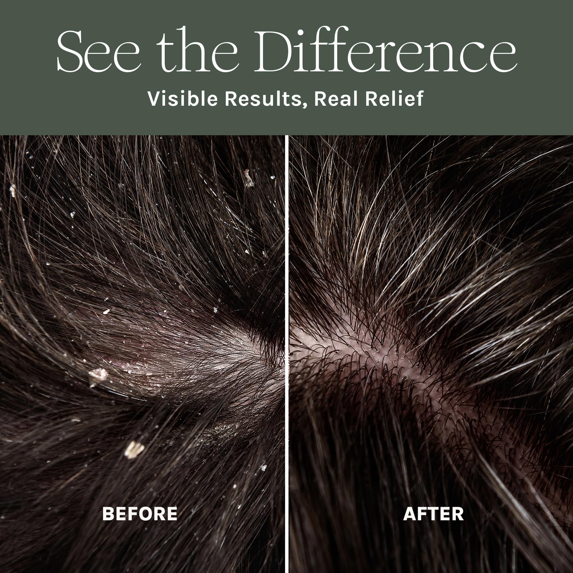Purist Dandruff Spray close-up label highlights aloe vera and botanicals.