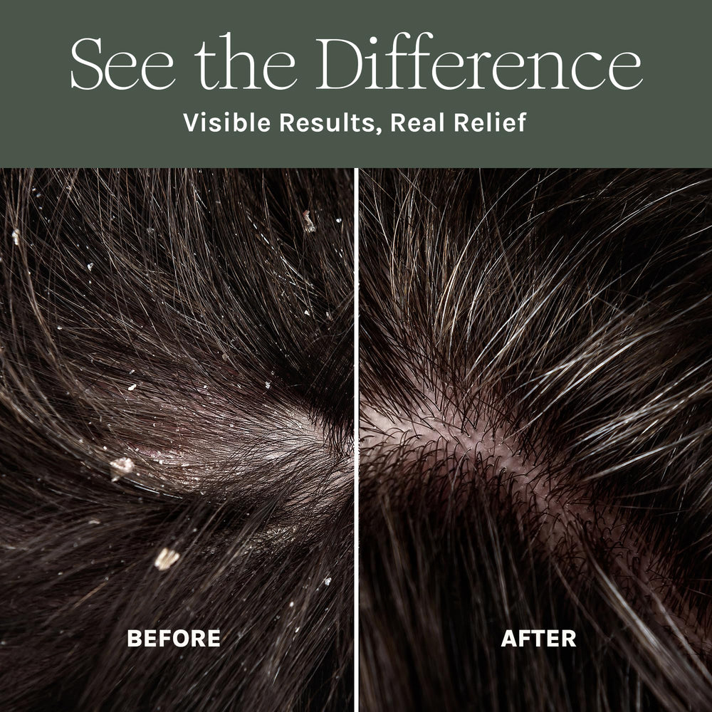 Purist Dandruff Spray close-up label highlights aloe vera and botanicals.