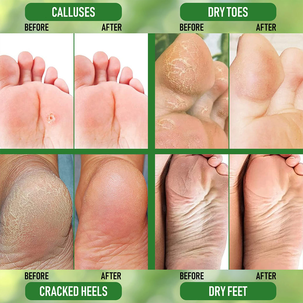PurOrganica Urea 20% Soft heels for sandal season features smoother skin.