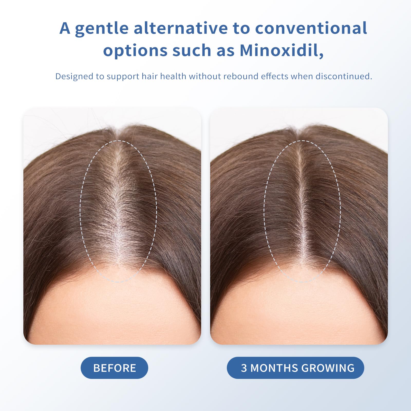 QGGQ Hair Growth Serum Roll-On applicator shows precise, mess-free delivery to thinning areas