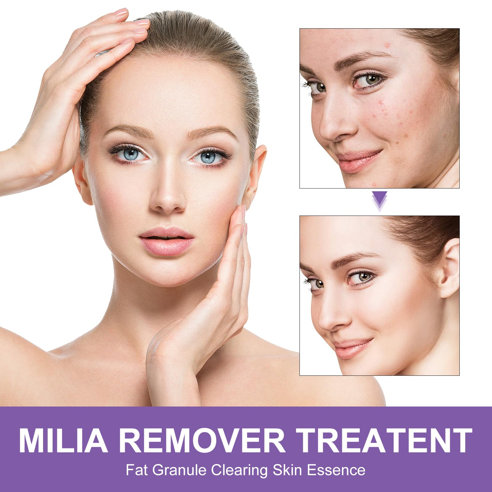 QKDBLWX Milia Remover face-area application—even coverage on pores and milia