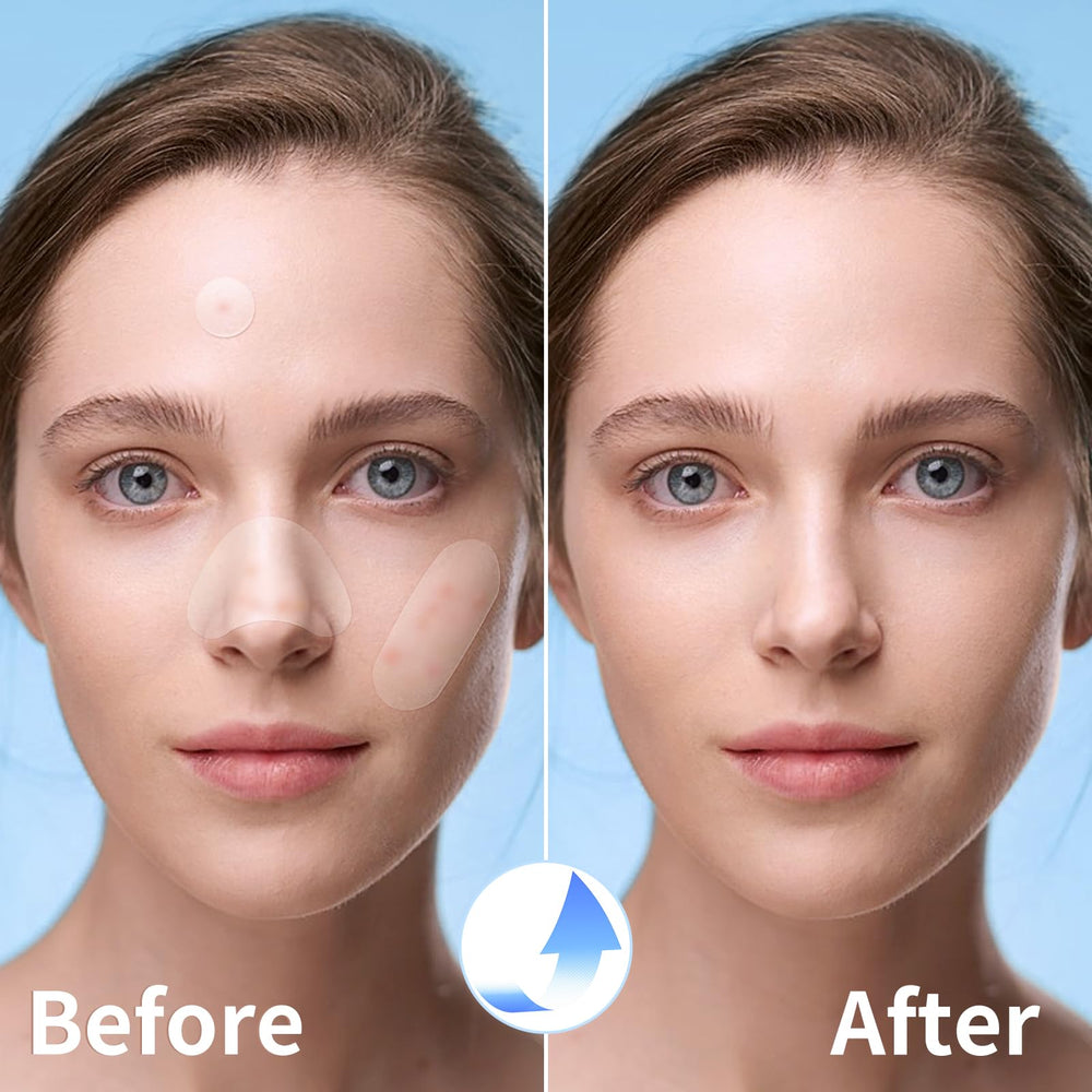 QUSTERE hydrocolloid patch absorbs fluids and provides a protective barrier over blemishes
