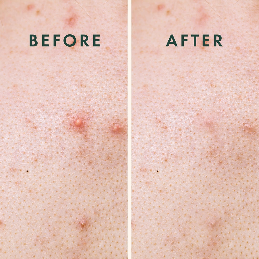 Rael Hydrocolloid patch closeup illustrating protective layer and absorption under the patch
