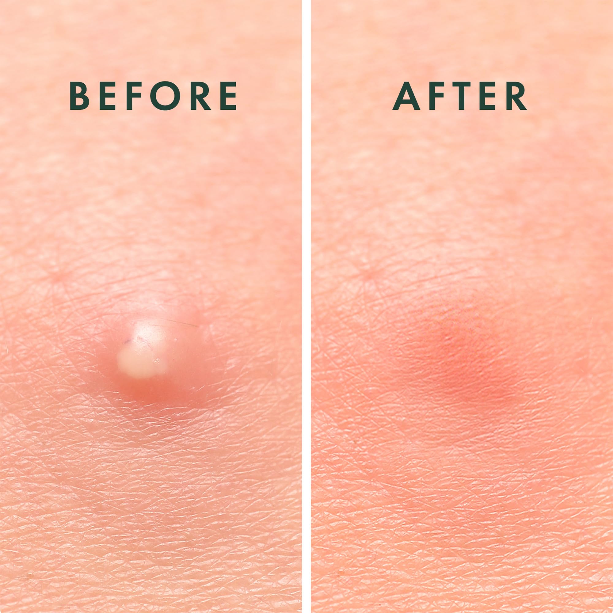Rael patch being applied offers quick, discreet blemish coverage.
