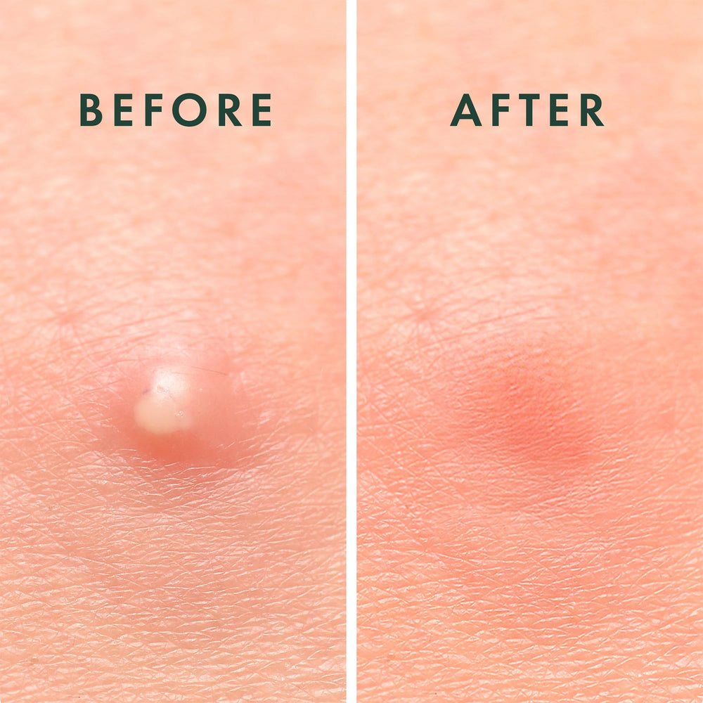 Rael patch being applied offers quick, discreet blemish coverage.