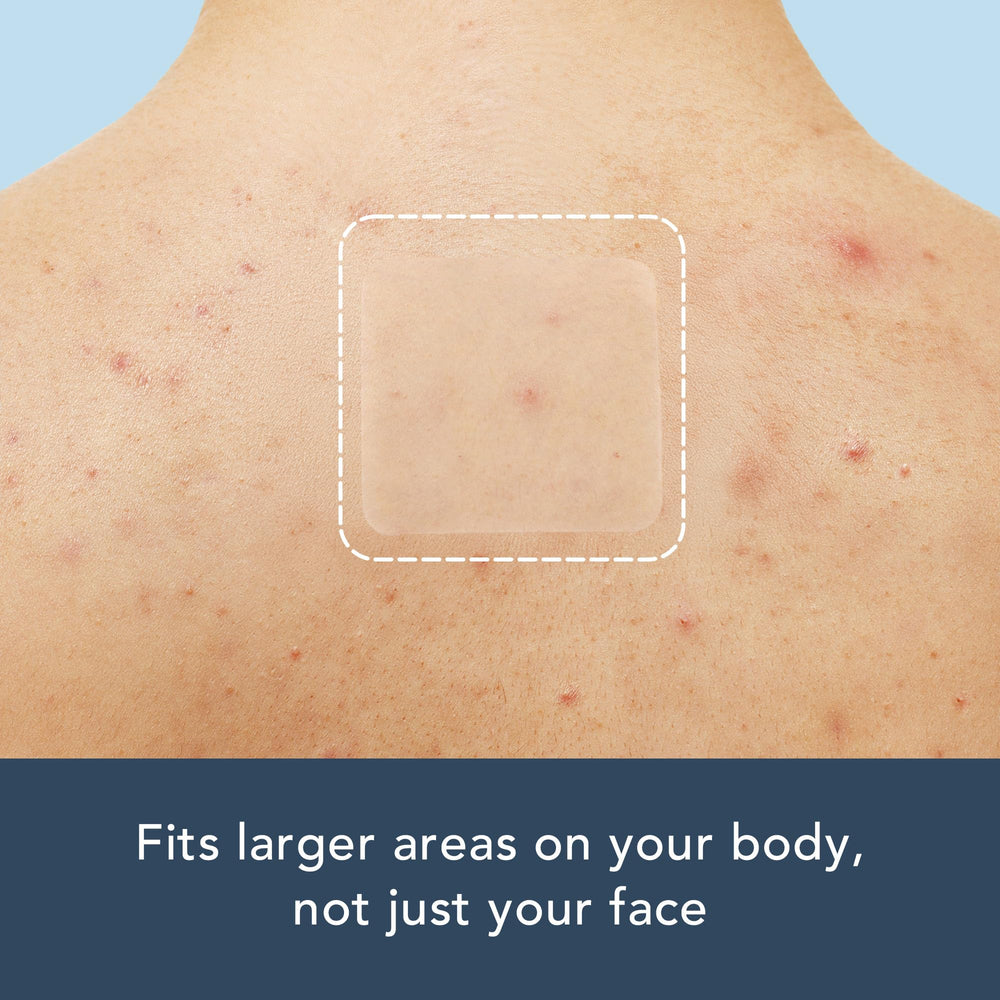 Rael Pimple Patches on back area demonstrates body acne use and coverage