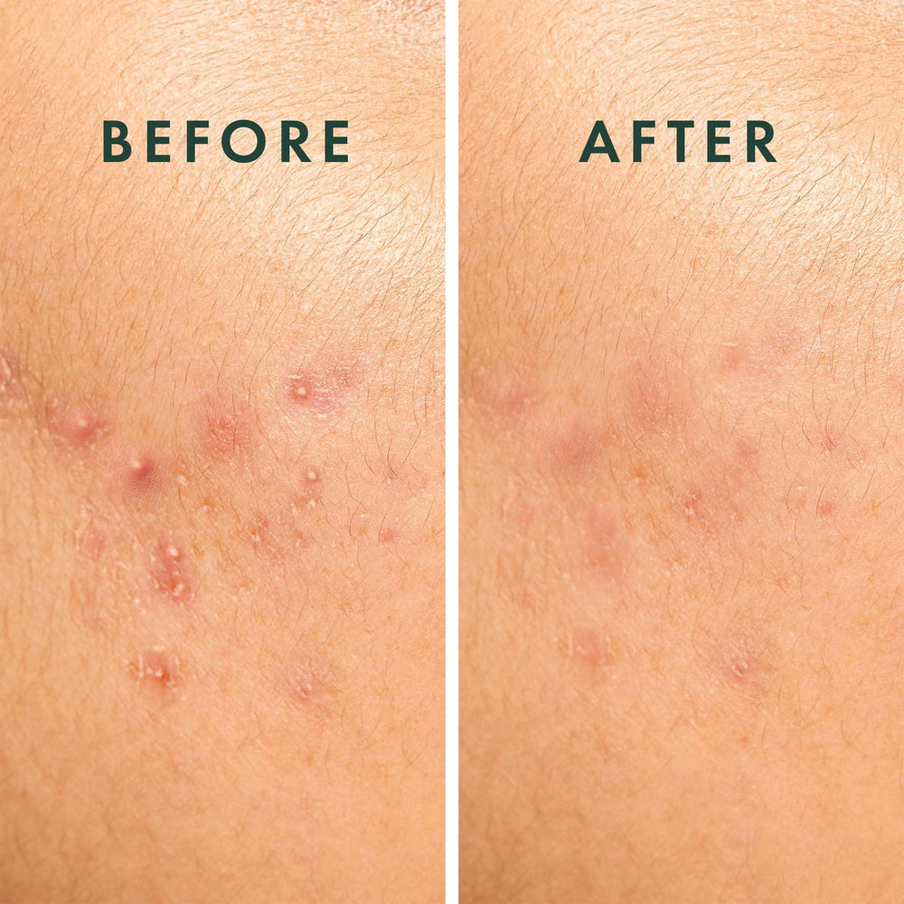 Rael pimple patches on cheek emphasize breathable hydrocolloid formula.