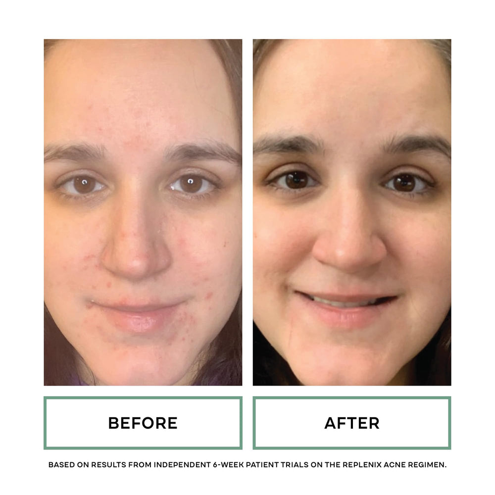 Replenix BP Acne Face Wash routine-use suggests daily cleansing for clearer skin.