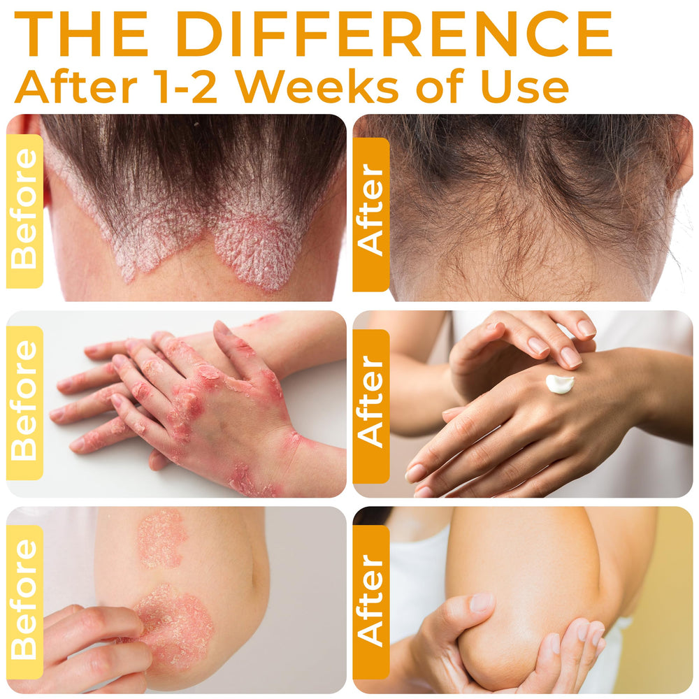 Rida Hair Psoriasis Cream scalp application highlights itch relief and even coverage