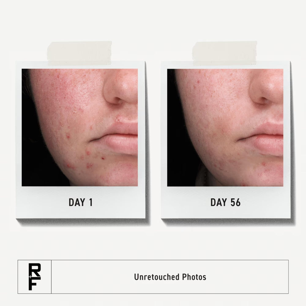 Rodan + Fields Spotless Daily Acne Wash pump image hints at oil control and fresh-looking skin.