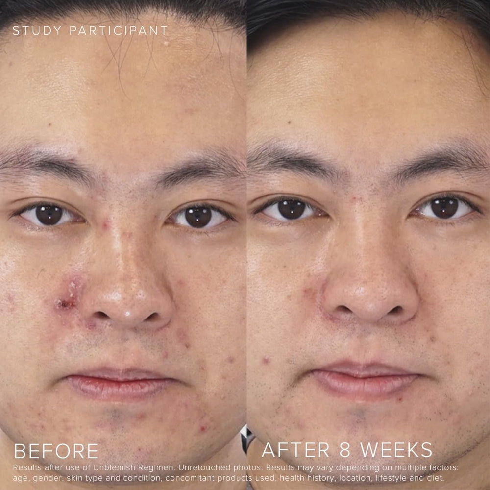 RODAN + FIELDS Unblemish bottle with label emphasizing benzoyl peroxide and ceramides for balanced care.