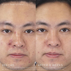 RODAN + FIELDS Unblemish bottle with label emphasizing benzoyl peroxide and ceramides for balanced care.