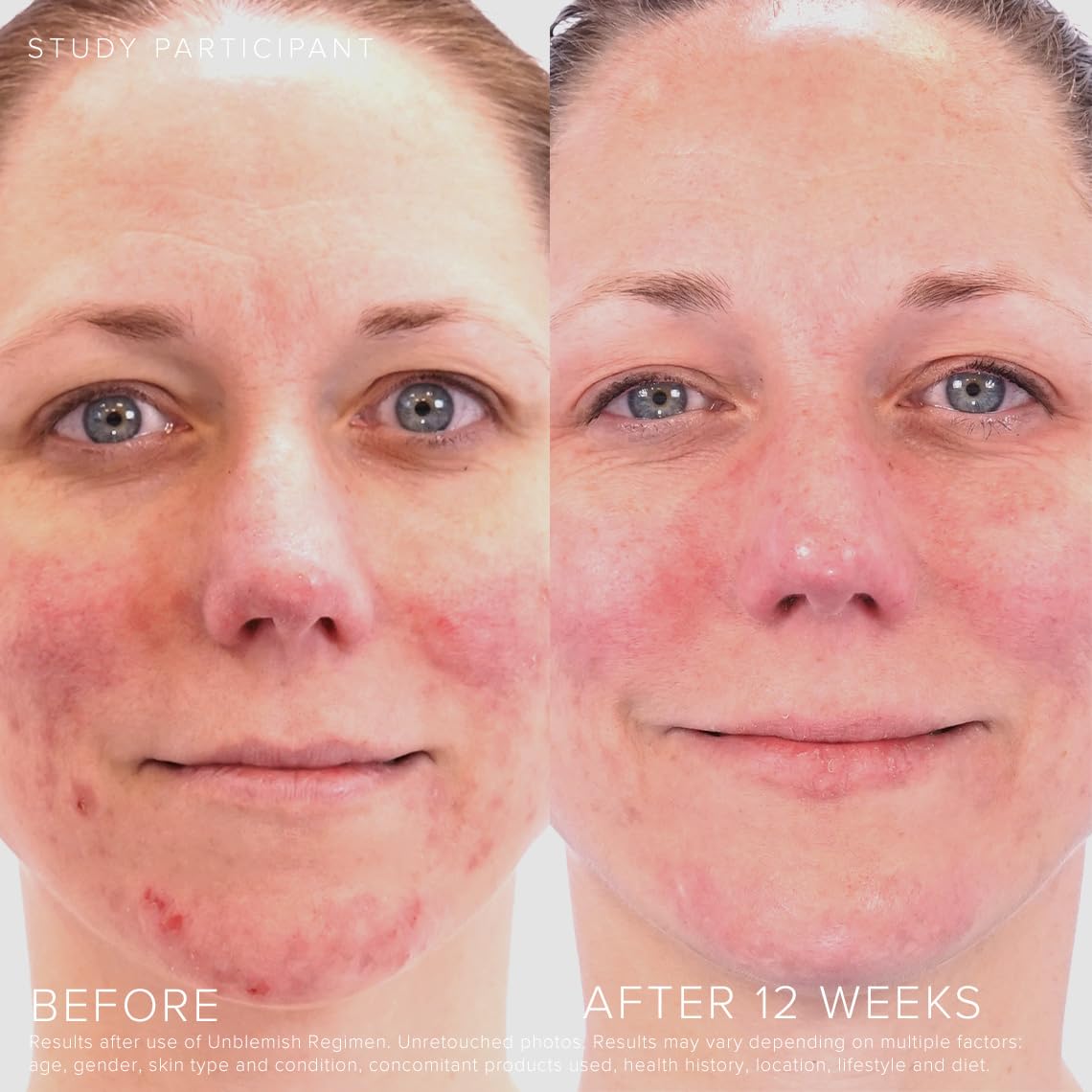 RODAN + FIELDS Unblemish precision pump image highlighting controlled dispense for targeted treatment.