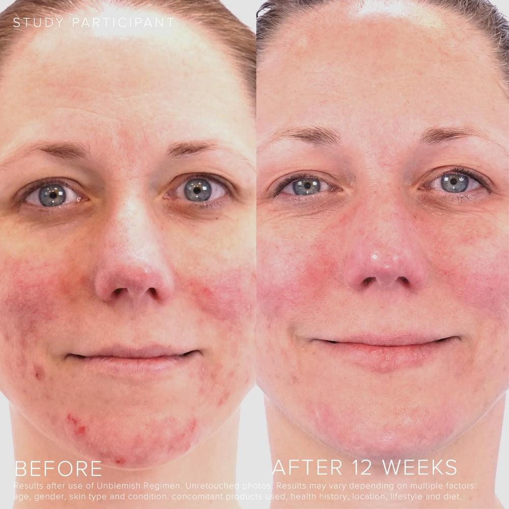 RODAN + FIELDS Unblemish precision pump image highlighting controlled dispense for targeted treatment.