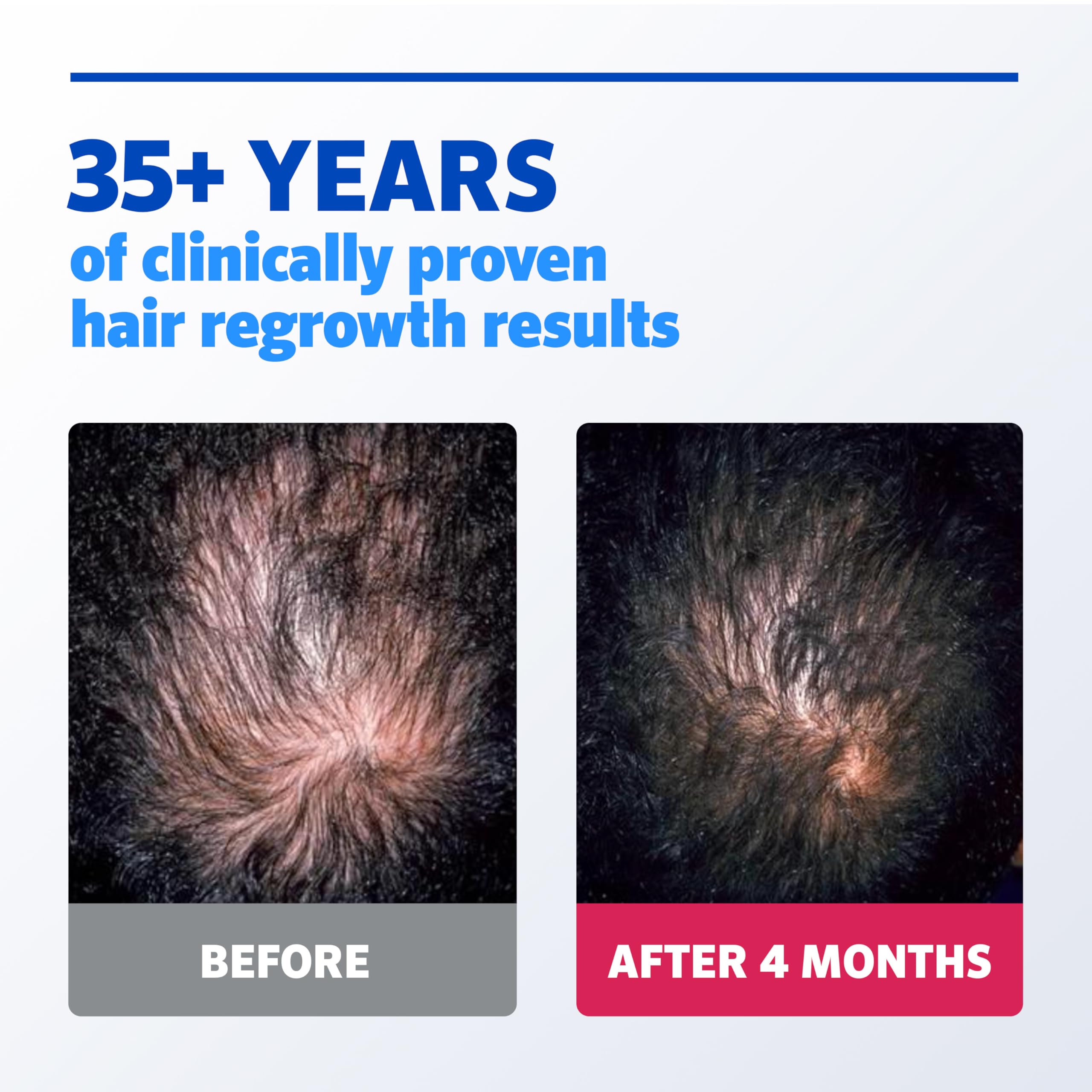 Rogaine vertex thinning area closeup highlighting crown treatment focus