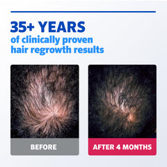 Rogaine vertex thinning area closeup highlighting crown treatment focus
