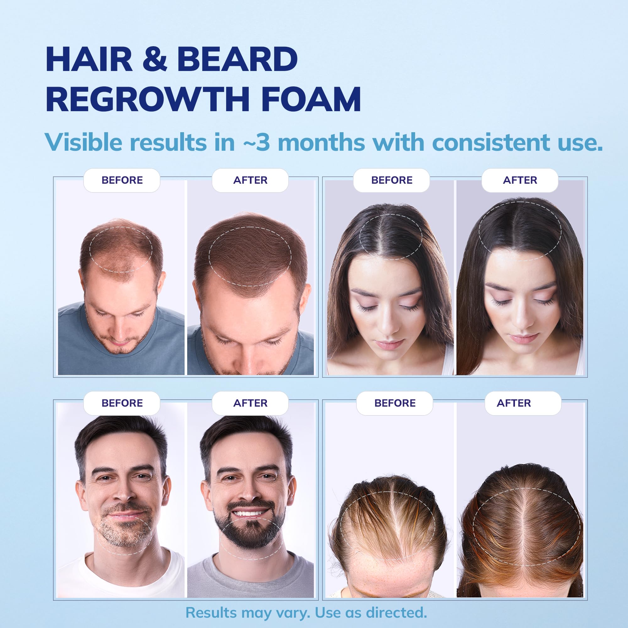 RootStim minoxidil foam applied to crown area for thinning management.
