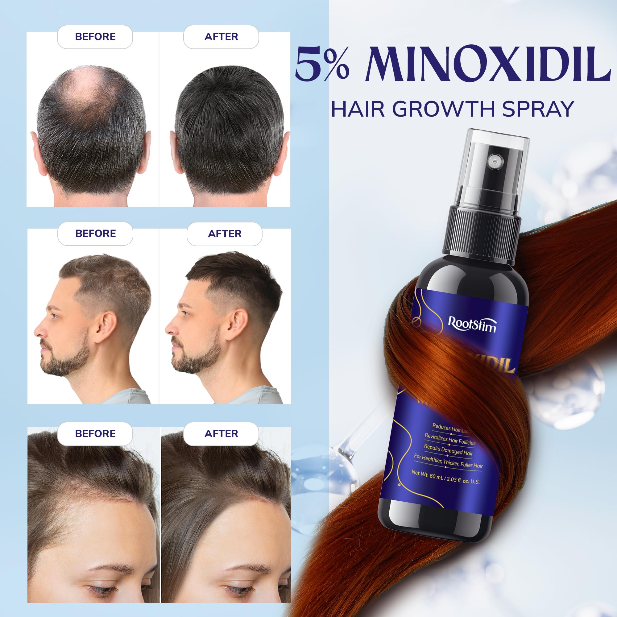 RootStim minoxidil scalp treatment applied to thinning areas for targeted support.