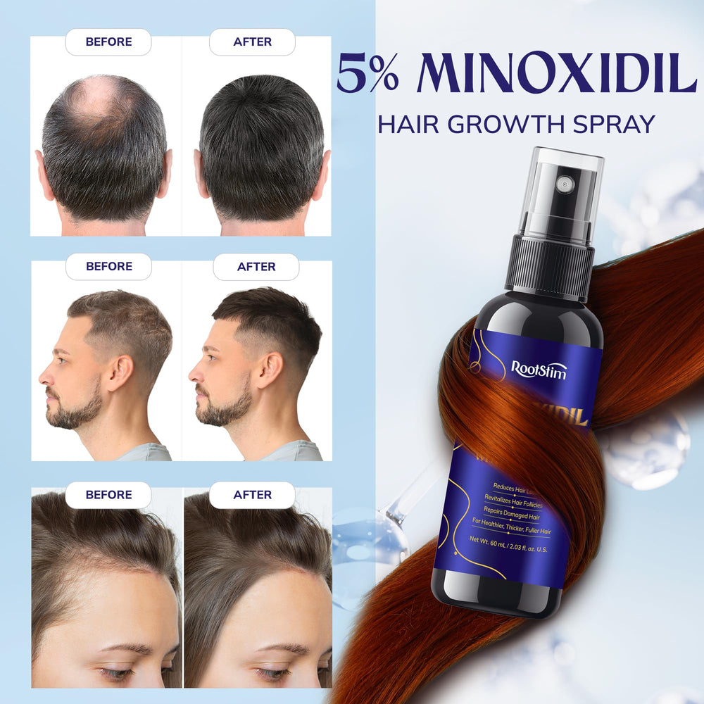 RootStim minoxidil scalp treatment applied to thinning areas for targeted support.