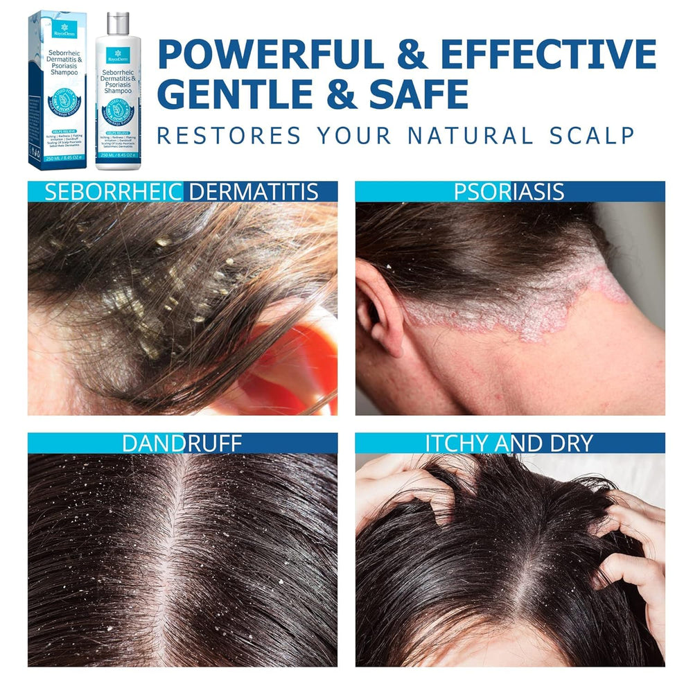 Roycederm dandruff shampoo scalp detail showing flakes reduction