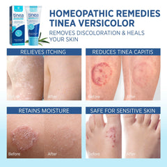 Roycederm-deep-moisturizing-formula-application shows creamy texture that nourishes dry, irritated skin.