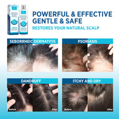 Roycederm seborrheic dermatitis conditioner bottle smooths and balances