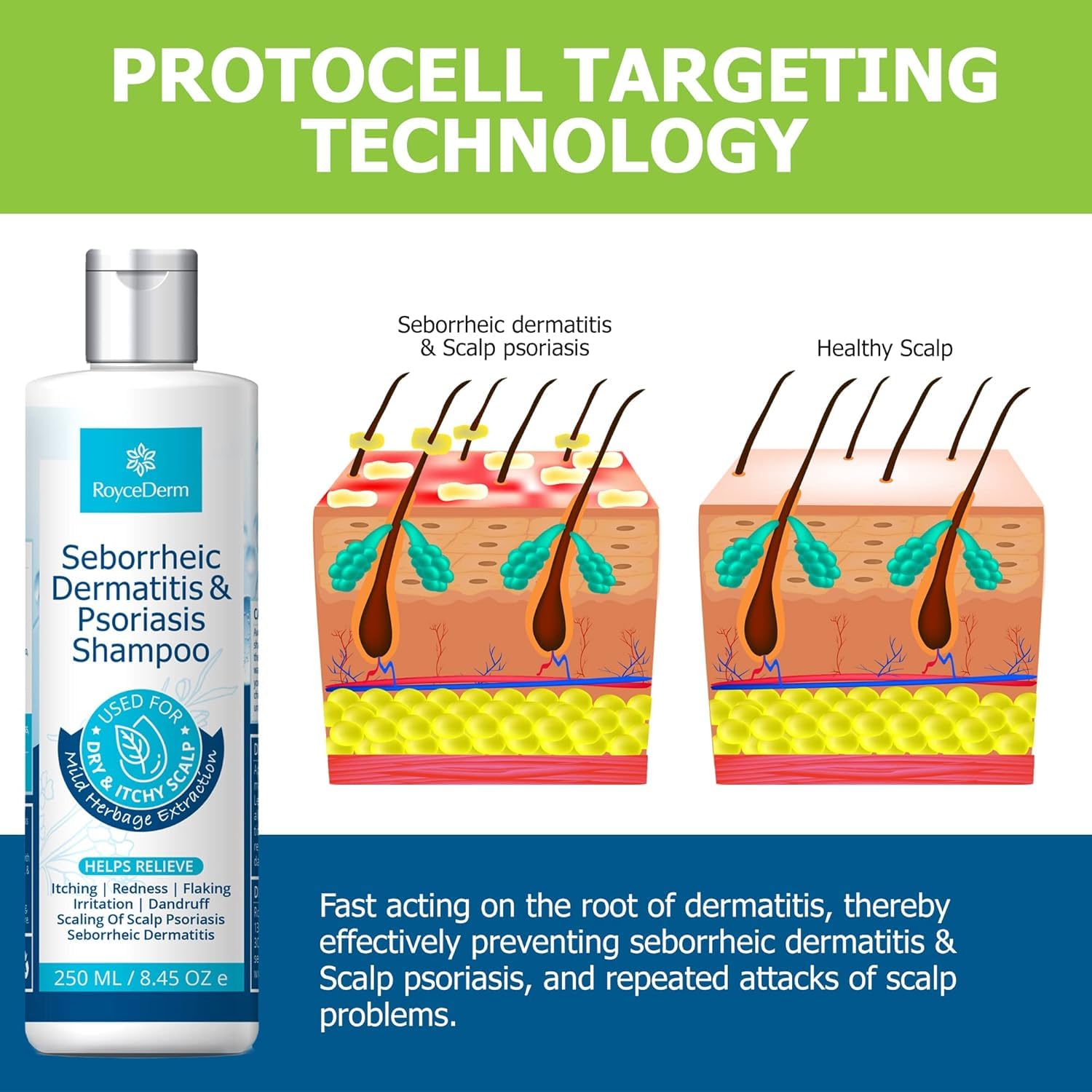 Roycederm seborrheic dermatitis shampoo rinse scene for easy use