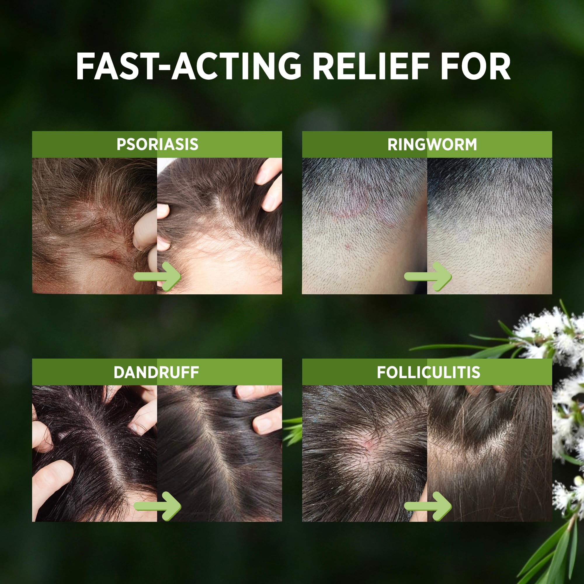 Roycederm Tea Tree Scalp Relief Spray ingredients highlight tea tree oil and salicylic acid.