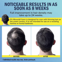 Ruahouine Minoxidil Foam quick-dry formula for daily routine.