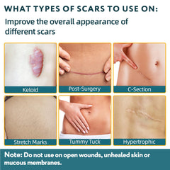 RWT silicone scar tape breathable adhesive demonstrates comfortable all-day wear