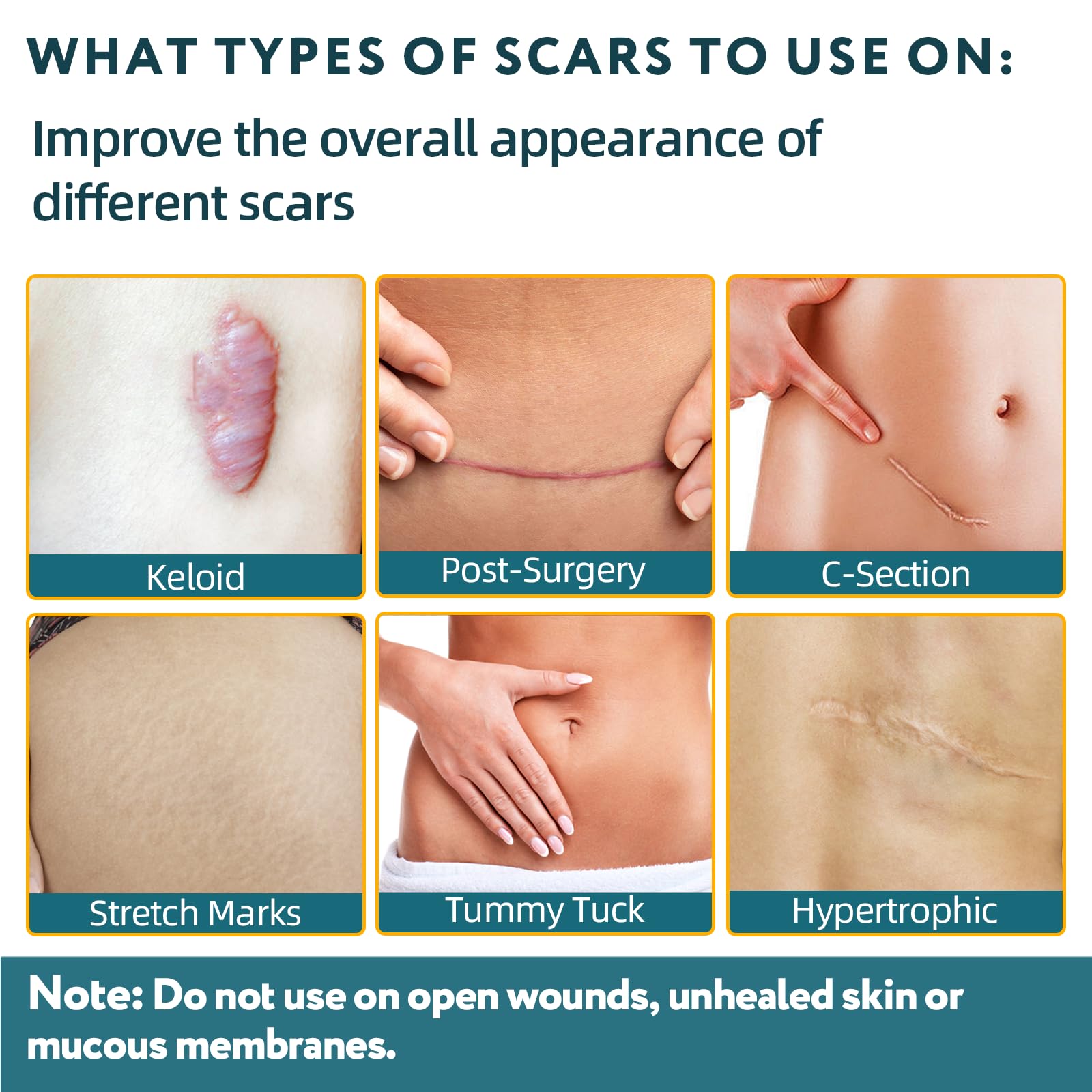 RWT silicone scar tape applied on skin demonstrating flexible wear