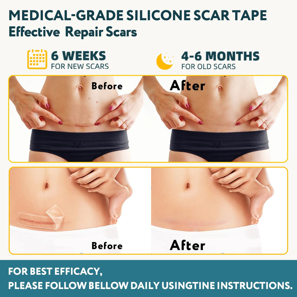 RWT silicone scar tape close-up highlights soft medical-grade silicone for skin-friendly wear