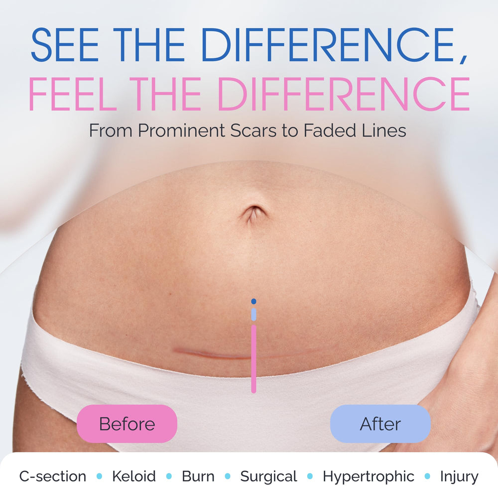 ScarScience burn scar care visuals suggesting improved skin pliability.