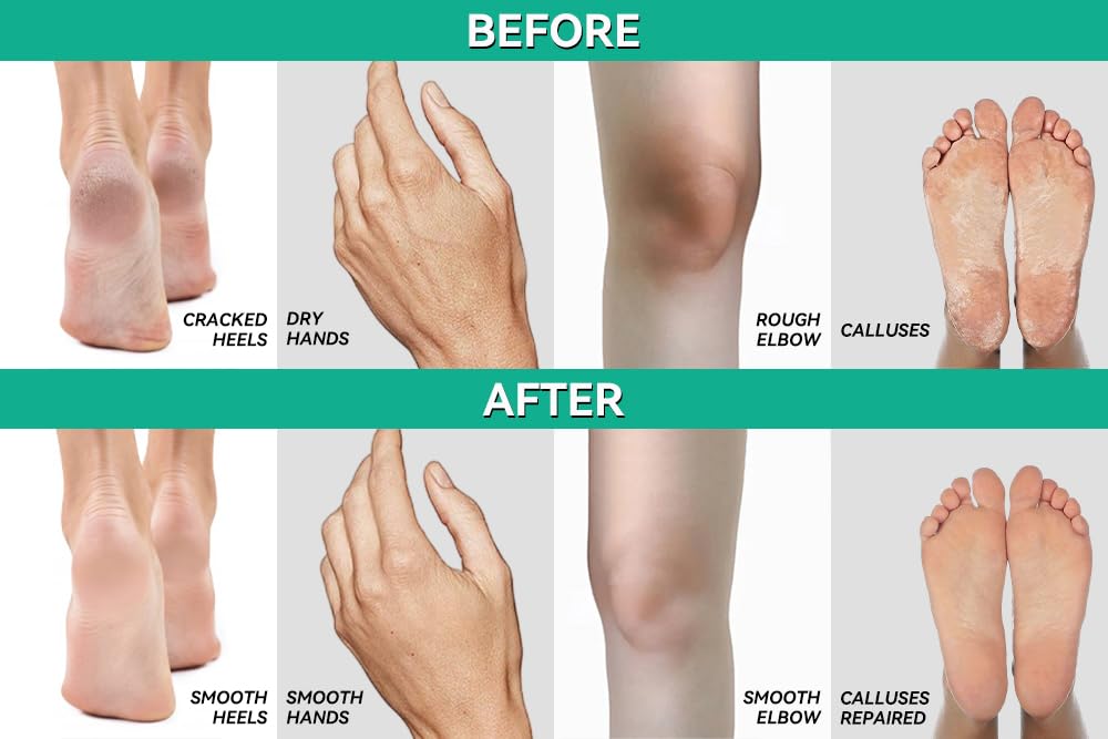 Moisturized heels elbows and hands visual with CLEAR 40