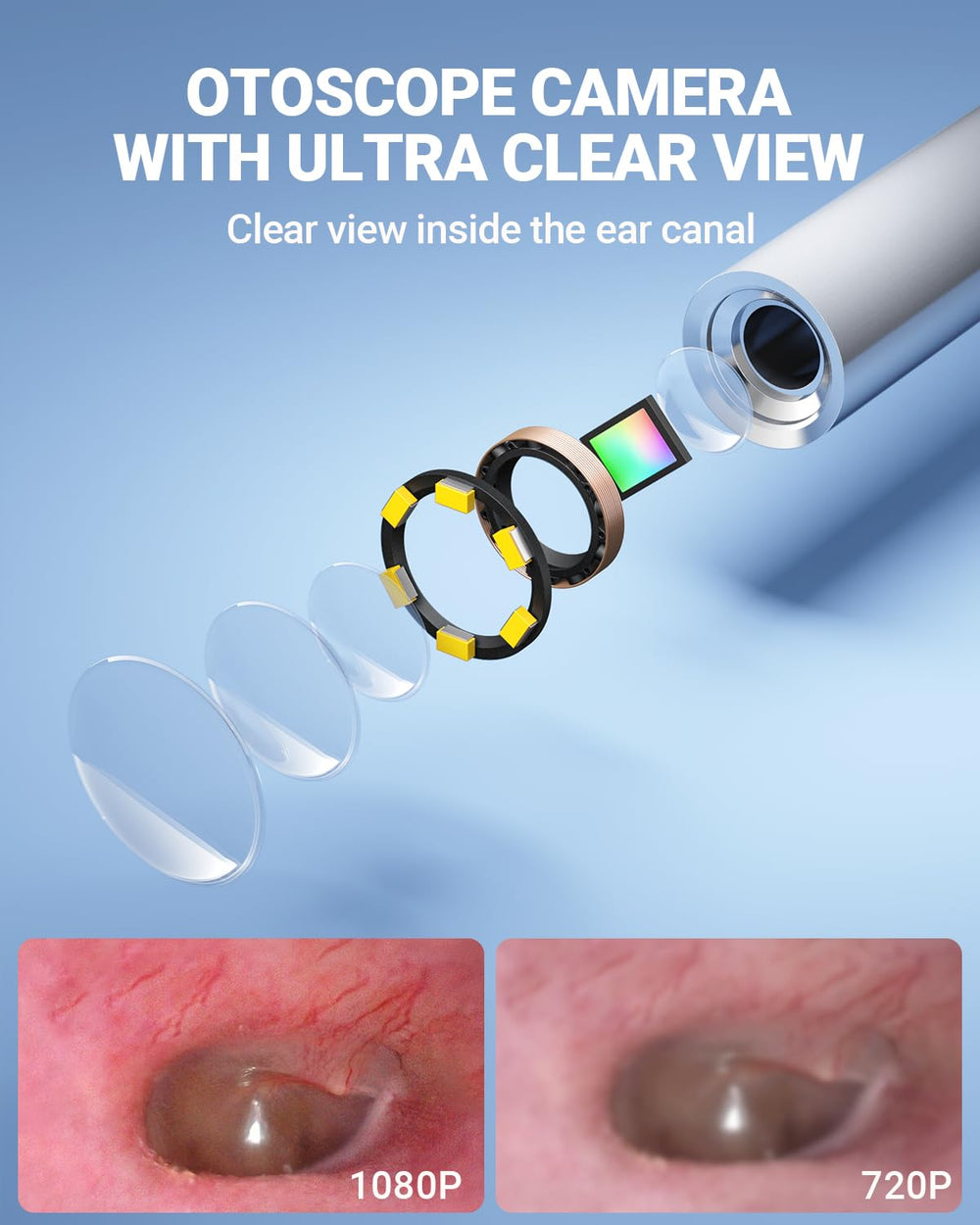 ScopeAround otoscope with gyroscope stabilization for steady imaging