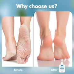 SENKYUNG 40% urea foot cream with coconut oil and aloe for rich moisturizing