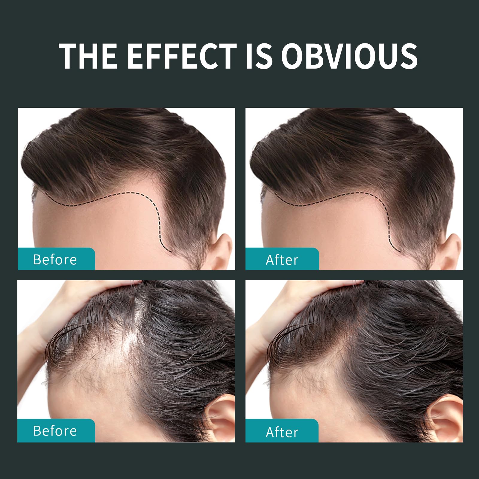 Sevich Hair Fiber Thickener suitable for both men and women.