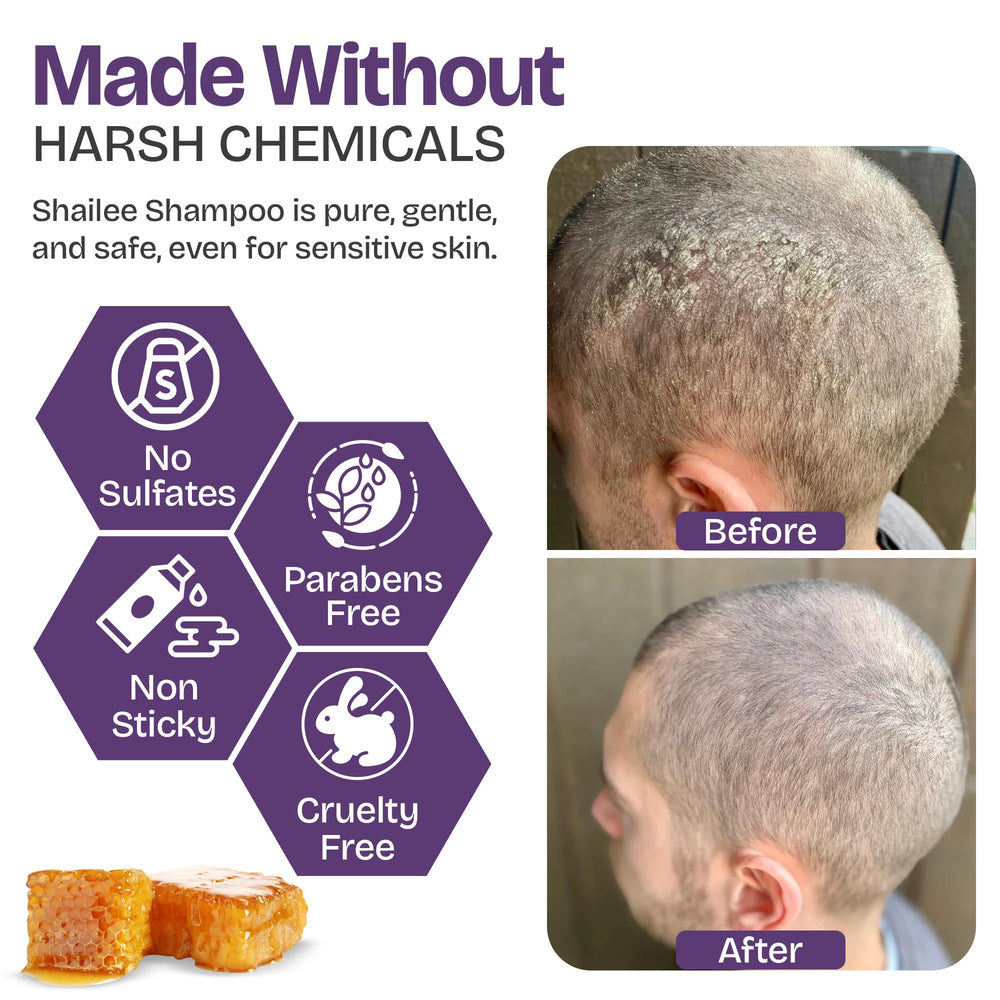 Shailee psoriasis shampoo rich lather showing exfoliation of flakes and irritation relief.
