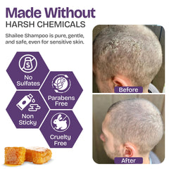 Shailee psoriasis shampoo rich lather showing exfoliation of flakes and irritation relief.