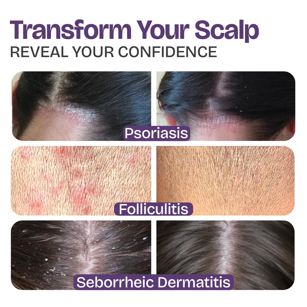 Shailee psoriasis shampoo hands pouring into palm demonstrates easy, gentle daily scalp care.