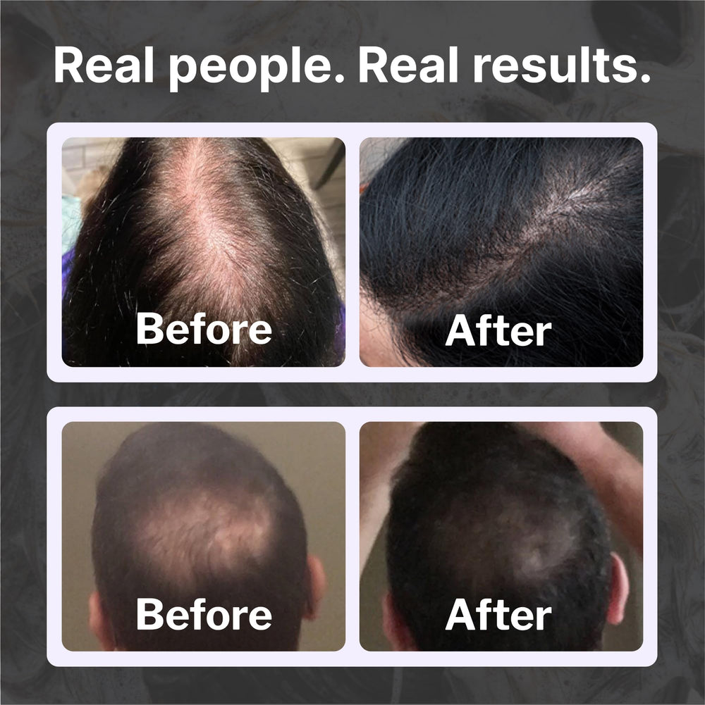 Shapiro MD Natural Hair Kit saw palmetto berries help support healthy follicles