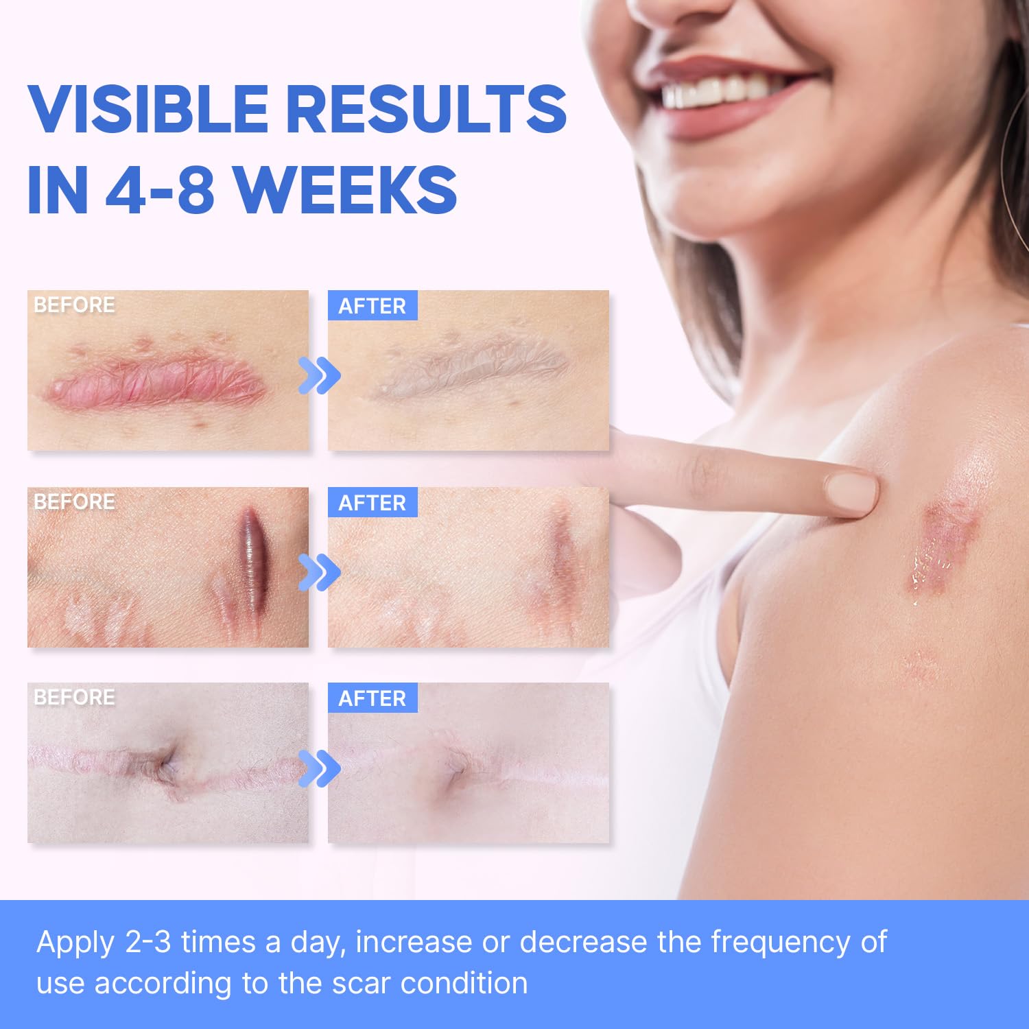 Sielkin scar sheets two-pcs pack closeup suitable for silicone scar management.