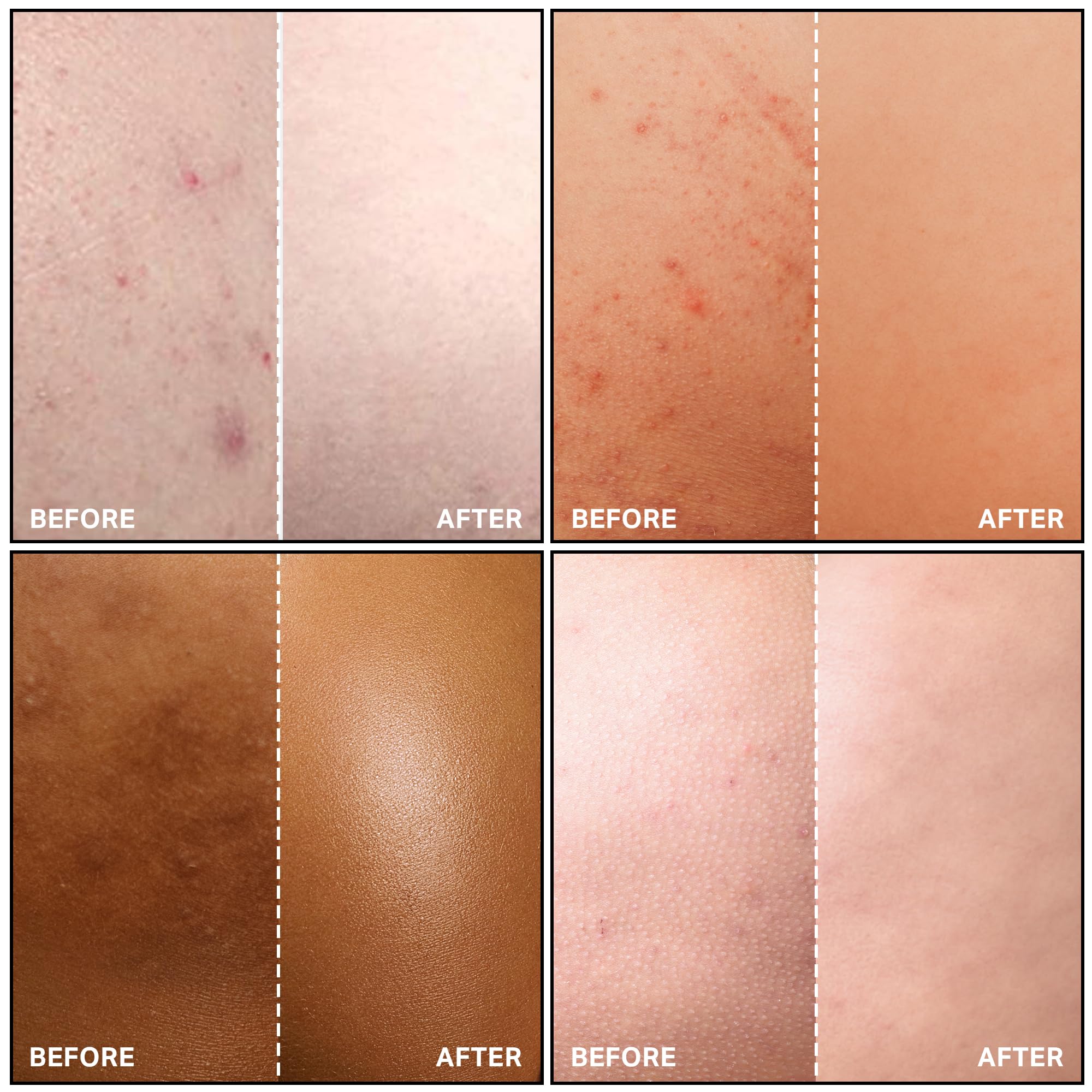 SKINBOSS Anti-Blemish Body Lotion lightweight hydration across the body for comfort.