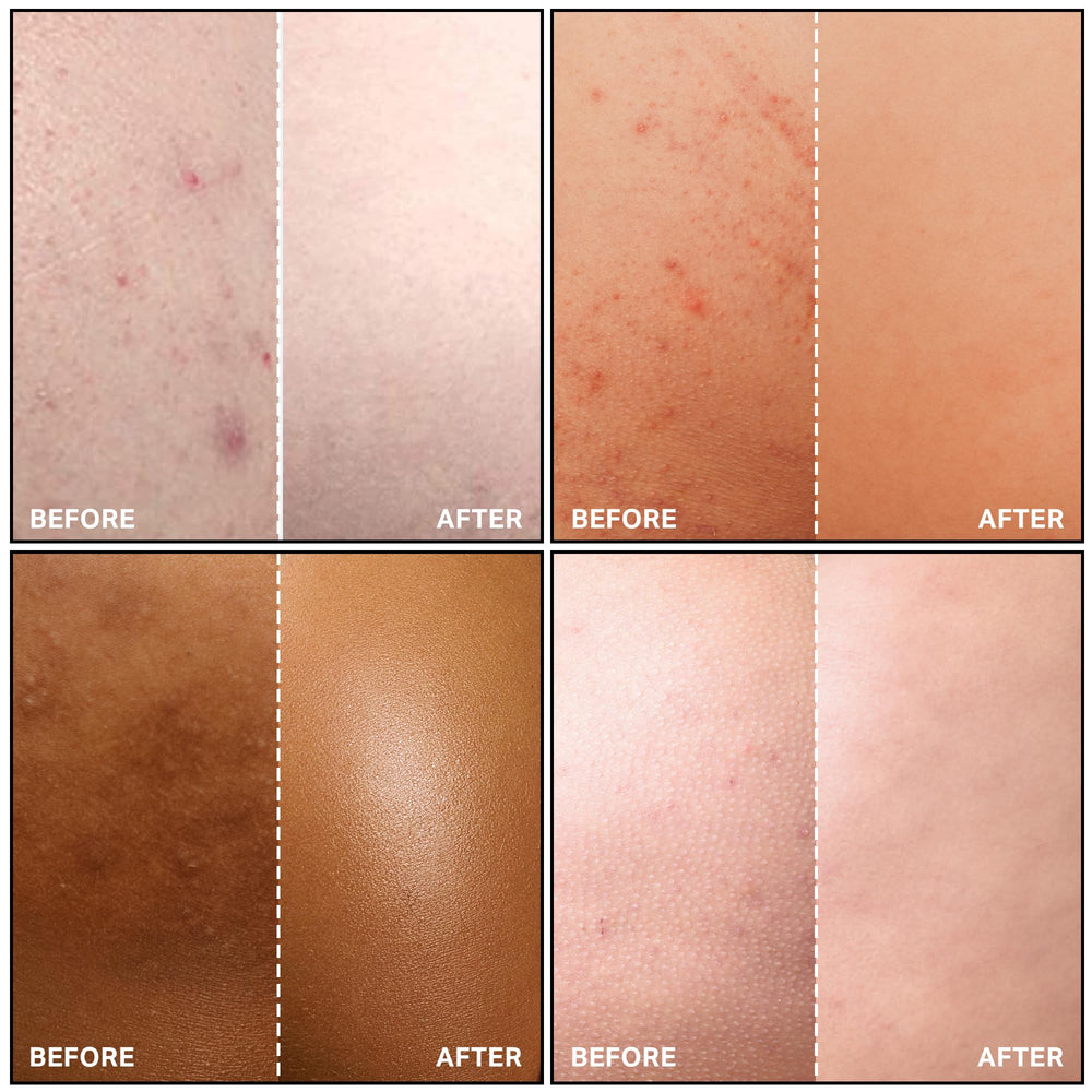 SKINBOSS Anti-Blemish Body Lotion lightweight hydration across the body for comfort.