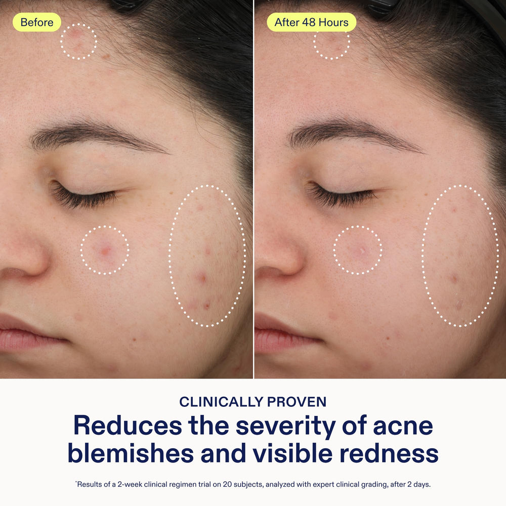 Skinfix 2% BHA Spot Treatment application dot demonstrates precise spot use on blemishes.