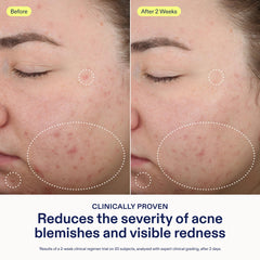 Skinfix 2% BHA Spot Treatment on-skin application targets acne-prone areas.