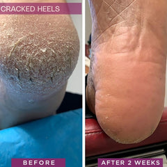 SkinIntegra Rapid Crack Repair for diabetic feet suggests supportive care for dry, fissured skin.