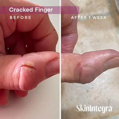SkinIntegra Rapid Crack Repair close-up on heels demonstrates relief from cracks.