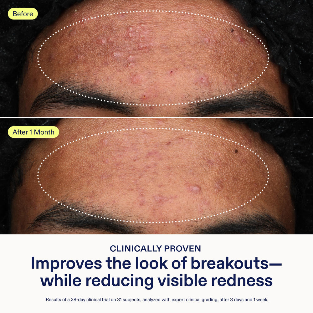 Texture swirl demonstrates lightweight, non-greasy serum ideal for smoothing breakouts.