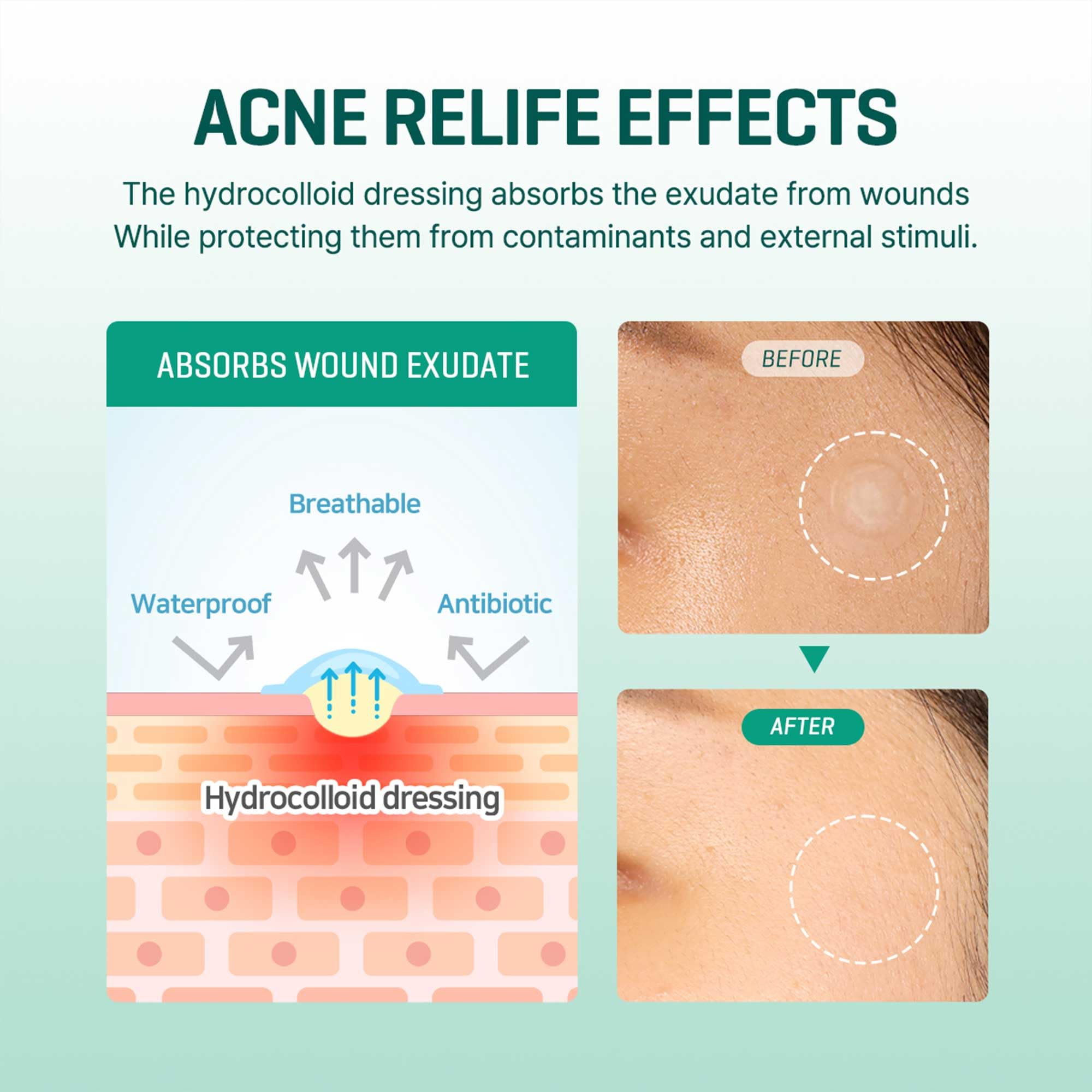 SOME BY MI invisible patch wear demonstrated for discreet blemish coverage under makeup.